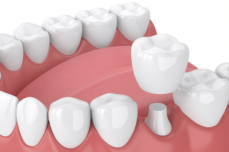 Dental Crowns in Irving